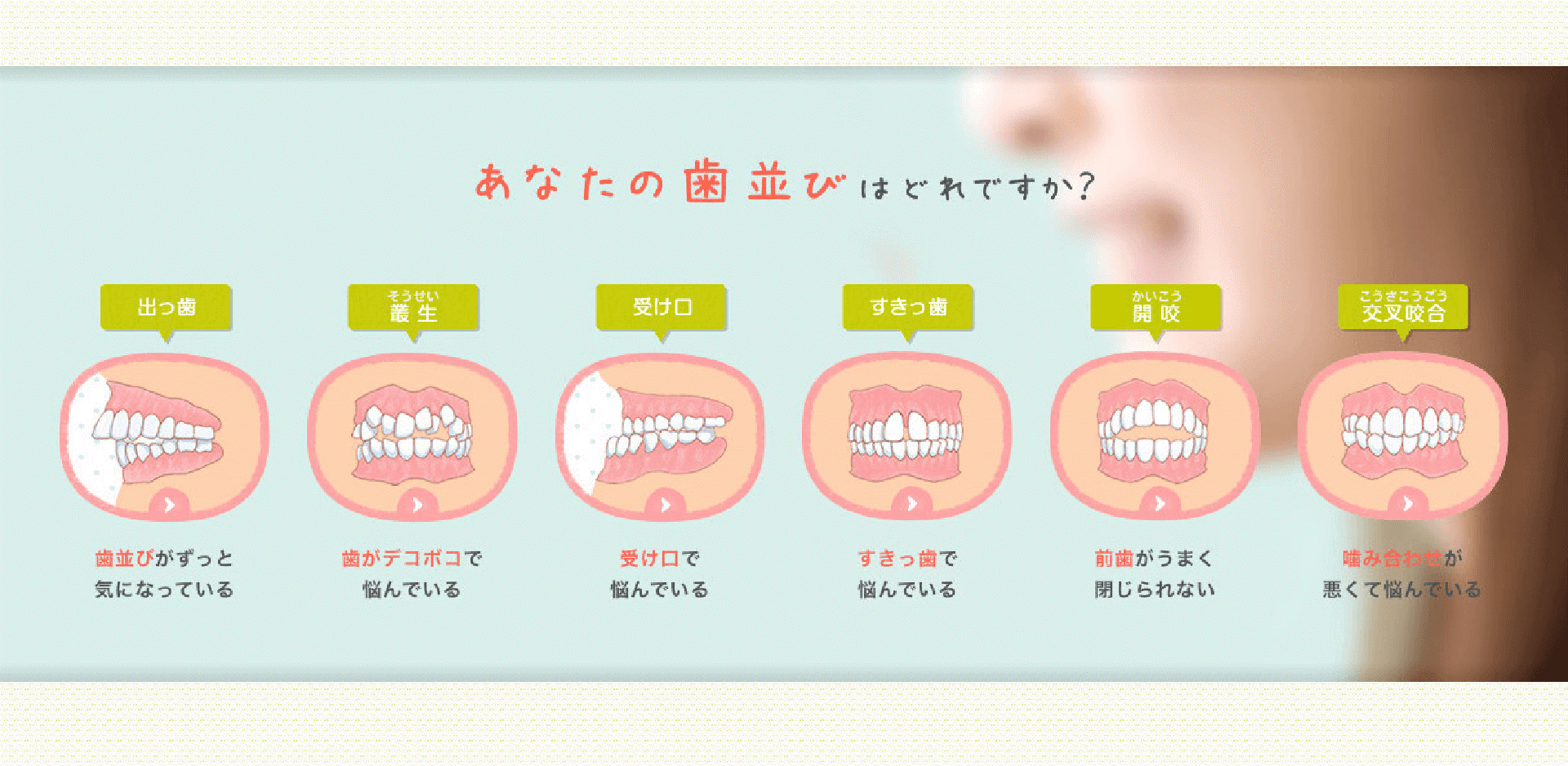 あなたの歯並びはどれですか？出っ歯・叢生・受け口・すきっ歯・開咬・交叉咬合